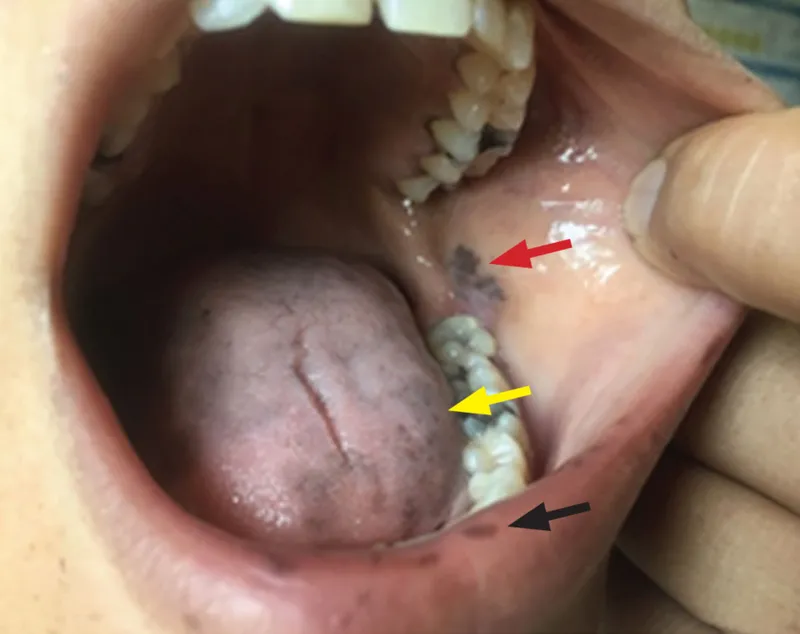 Hyperpigmentation of gums and buccal mucosa in Addison's