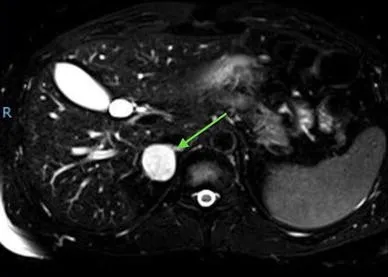 Adrenal Pheochromocytoma on T2-weighted MRI