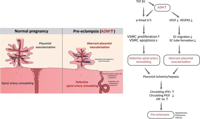 Preeclampsia: Spiral Artery Remodeling & Pathophysiology