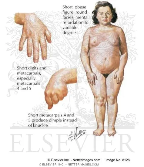 Albright hereditary osteodystrophy: physical features