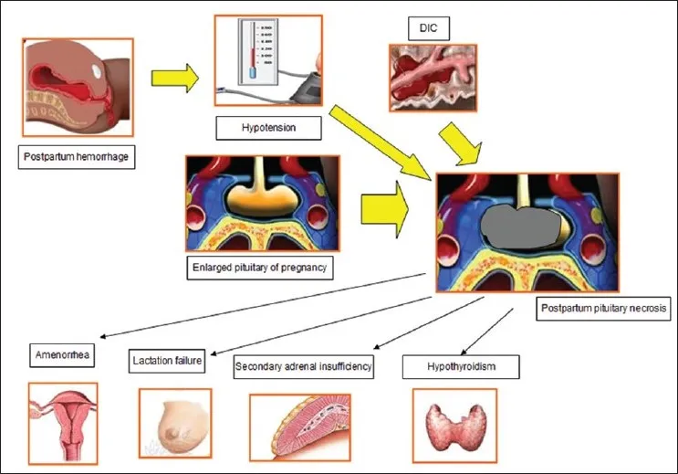 Sheehan Syndrome Pathophysiology