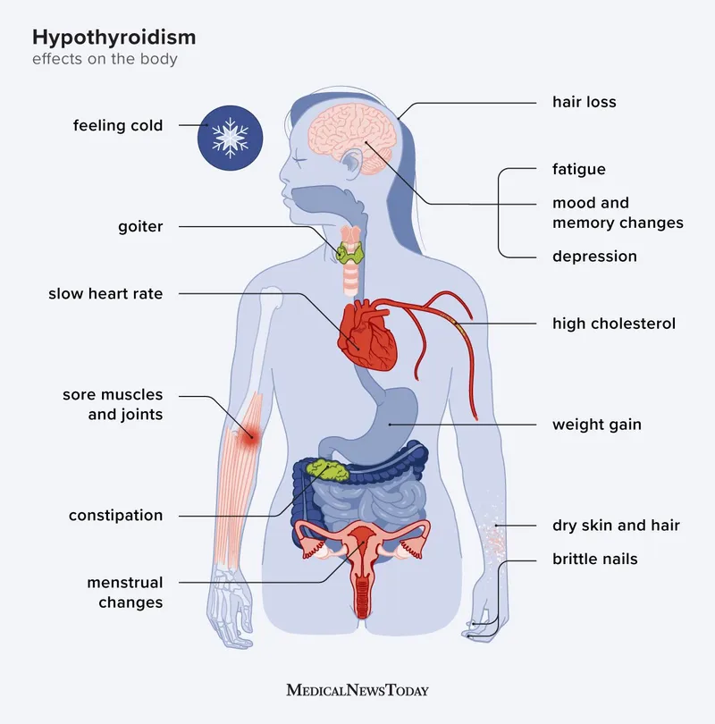 Hypothyroidism: Effects on the Body