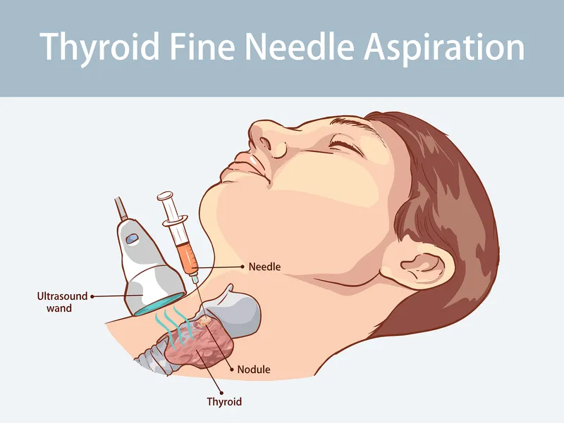 Ultrasound-guided fine-needle aspiration of thyroid nodule