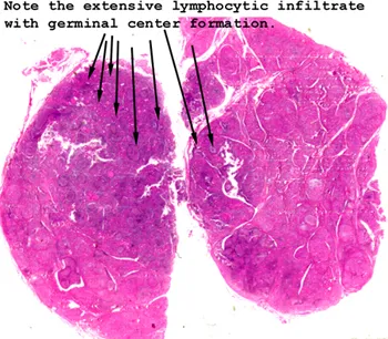 Thyroiditis: Lymphocytic Infiltrate and Germinal Centers