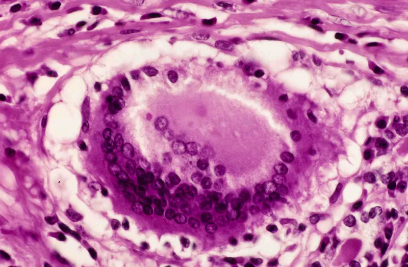 Granulomatous thyroiditis with giant cells