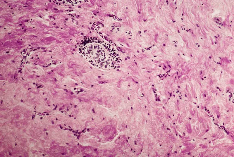 Riedel's Thyroiditis: Dense Fibrous Tissue and Lymphocytes