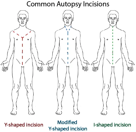 Common Autopsy Incisions: Y, Modified Y, and I-shaped