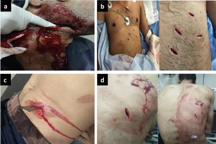 Comparison of stab, incised, and firearm wounds