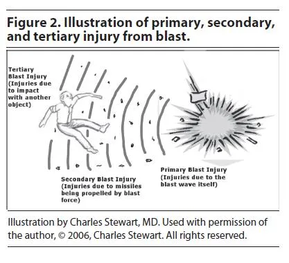 Primary, secondary, and tertiary blast injury mechanisms