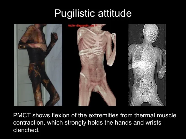 Pugilistic attitude in burn victim with PMCT