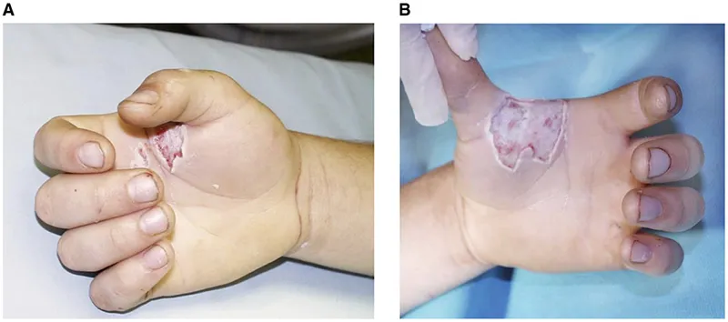 Electrical burn entry and exit wounds on hand