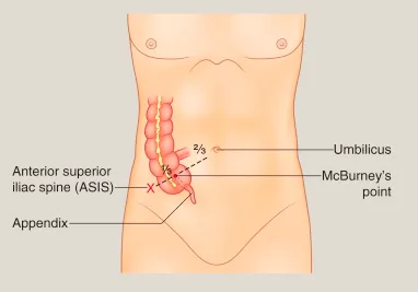 McBurney's Point and Appendix Location