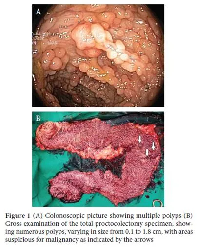 Colon polyps: Endoscopic view and gross specimen