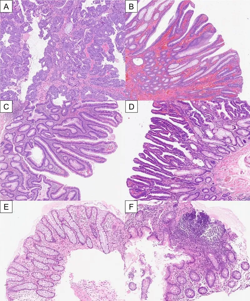 Histology of colon polyps: tubular, tubulovillous, villous