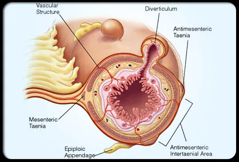 Colonic Diverticula Formation and Vasa Recta