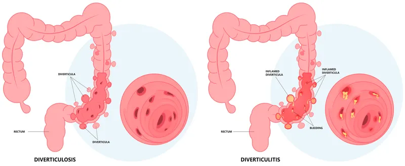 Diverticulosis vs. Diverticulitis