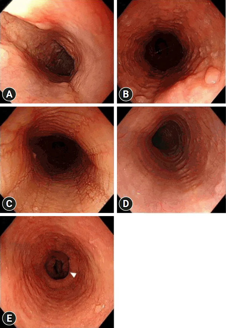 Endoscopic findings of various esophagitis types