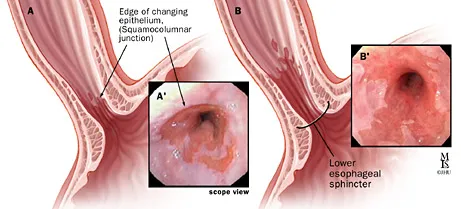 Barrett's Esophagus: Endoscopic and Anatomical Views
