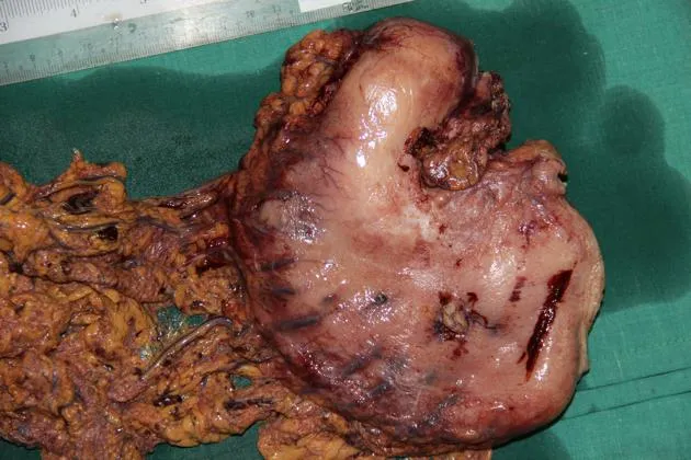 Gastric adenocarcinoma with ulcerated crater