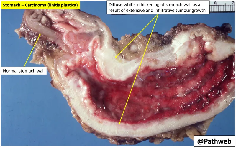 Linitis plastica gross specimen with thickened stomach wall