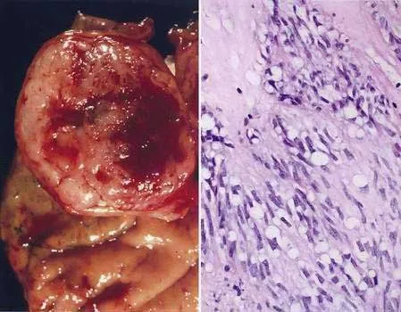 GIST: Gross and Microscopic Pathology