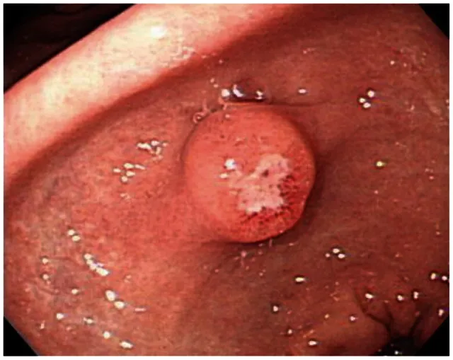 Endoscopic view of gastric polyp with ulceration