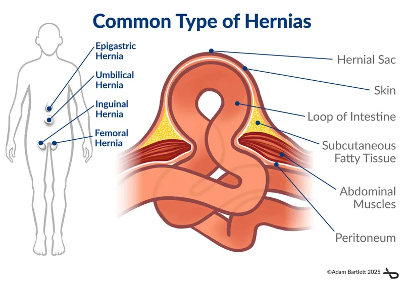 Common Types of Hernias and Anatomy