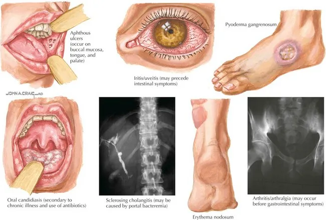 Extraintestinal Manifestations of Inflammatory Bowel Disease