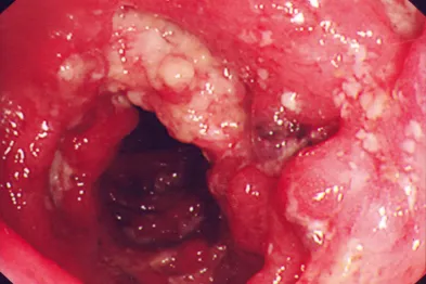 Endoscopic view of cobblestone mucosa in Crohn's disease