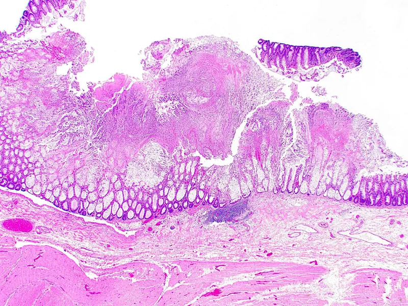 Pseudomembranous colitis: volcano lesion