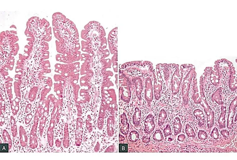 Celiac Disease: Normal vs. Atrophic Villi