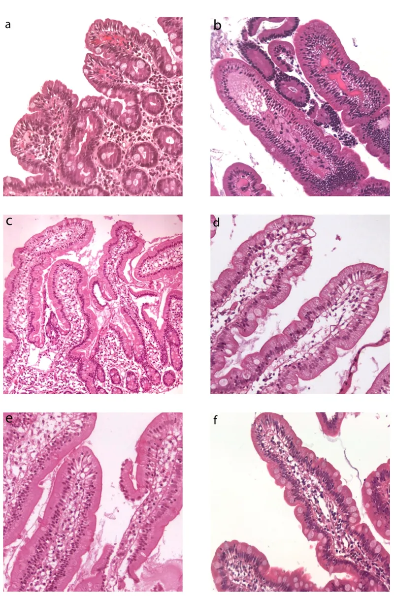 Villous atrophy in malabsorption syndromes