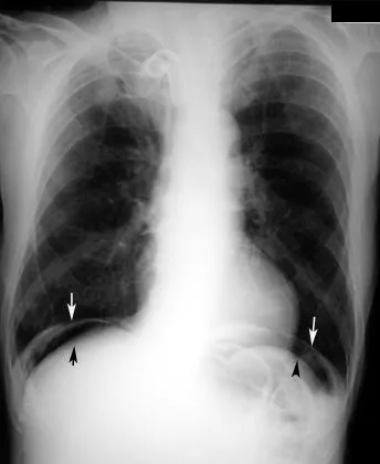 Upright CXR: Free subdiaphragmatic air (pneumoperitoneum)