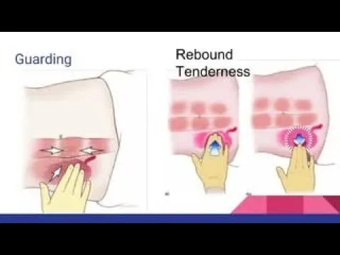 Guarding and Rebound Tenderness in Peritonitis