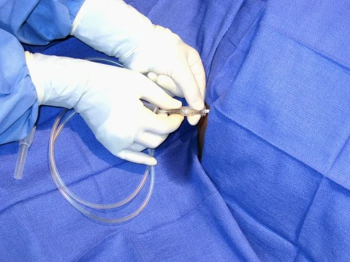 Paracentesis procedure for peritonitis diagnosis