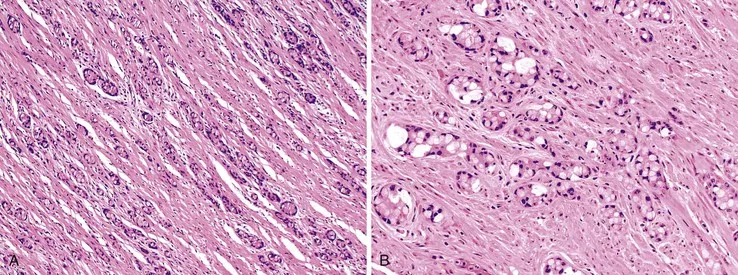 Appendiceal neuroendocrine tumor histopathology