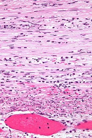 Acute appendicitis histopathology: neutrophils