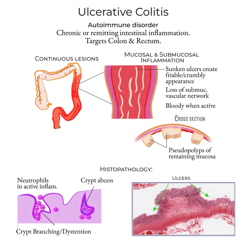 Ulcerative Colitis: Gross and Histopathology
