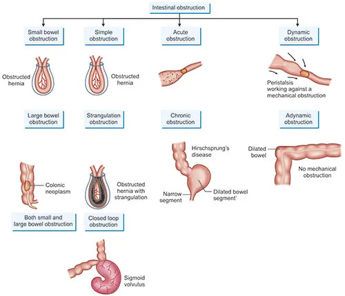 Types of Intestinal Obstruction