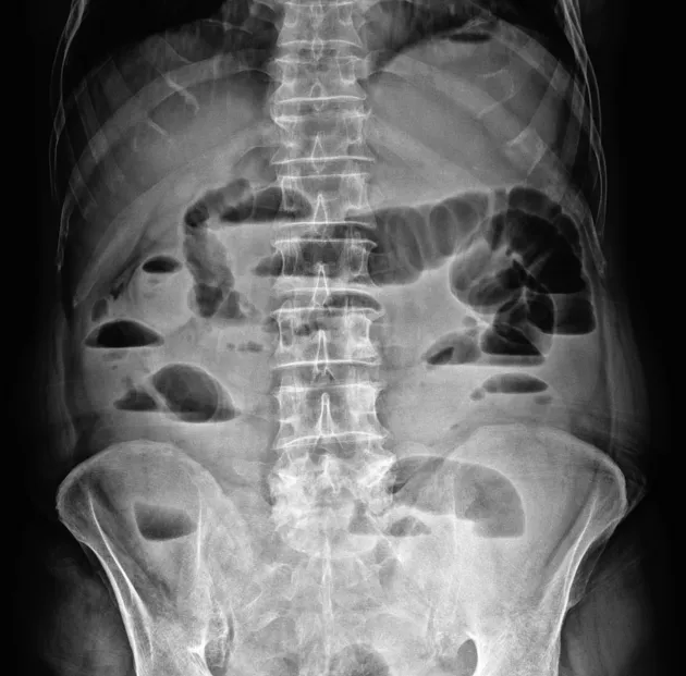 Abdominal X-ray with air-fluid levels in small bowel