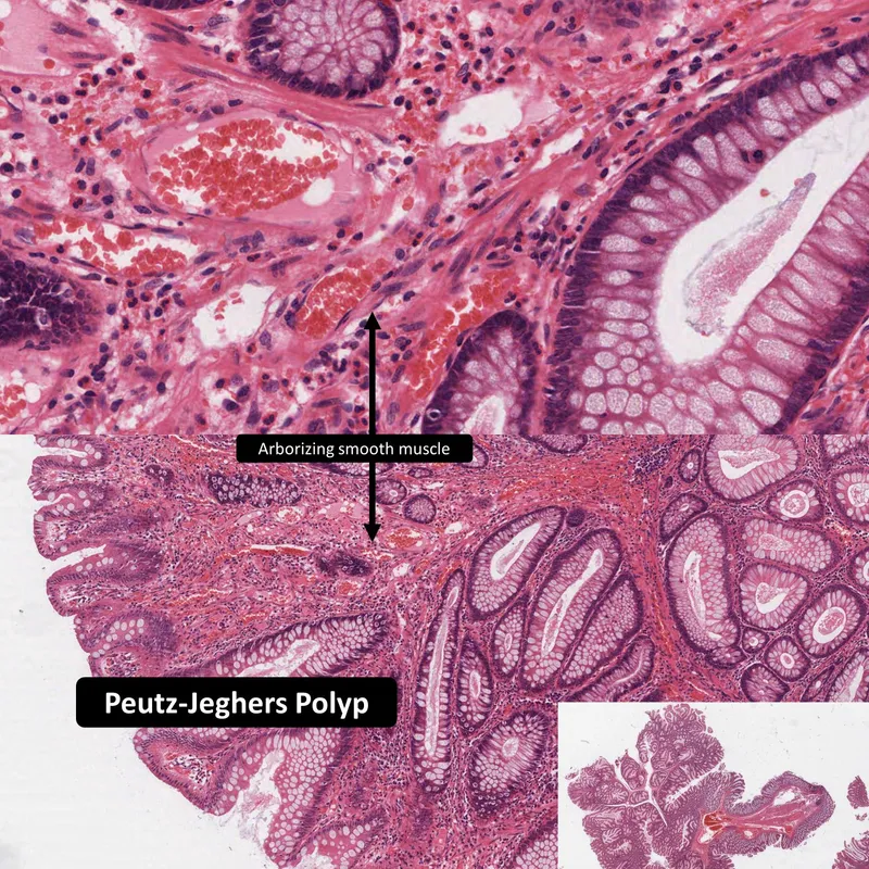 Histology of Peutz-Jeghers polyp