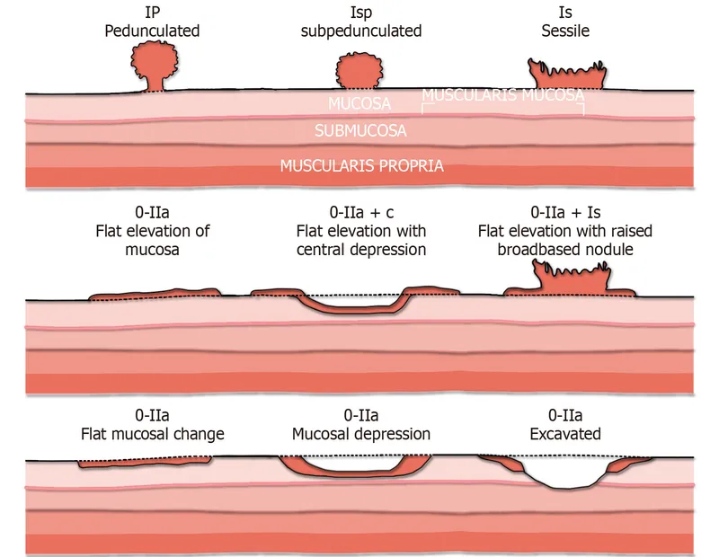Polyp Morphology and Paris Classification