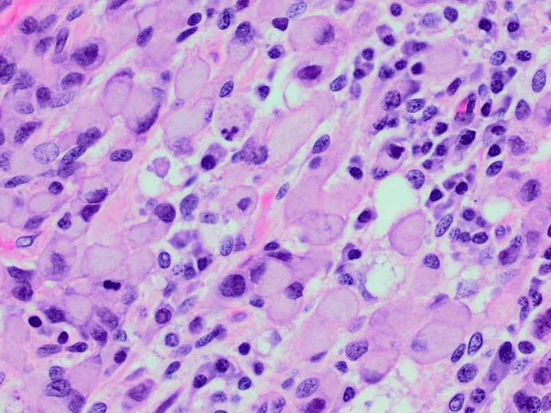Signet ring cells in gastric adenocarcinoma