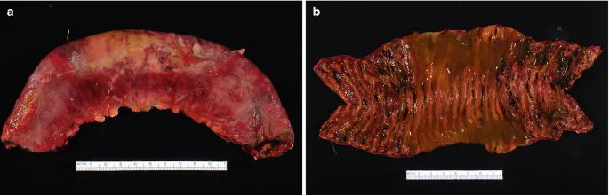 Ischemic bowel disease gross morphology
