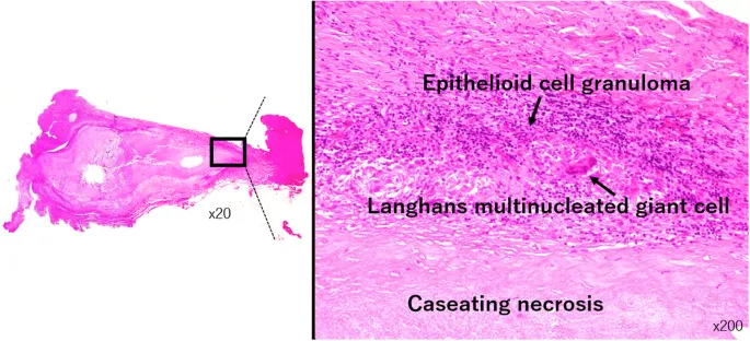 Granuloma with epithelioid cells and Langhans giant cell