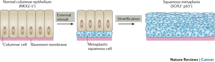 Squamous Metaplasia Development