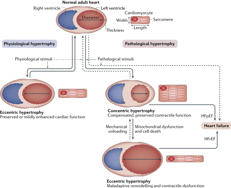 Cardiac Hypertrophy: Physiological vs. Pathological