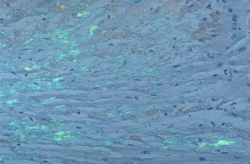 Amyloidosis: Apple-Green Birefringence with Congo Red