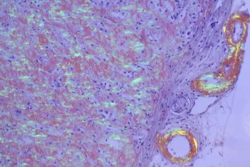 Amyloidosis: Congo Red Stain with Apple-Green Birefringence