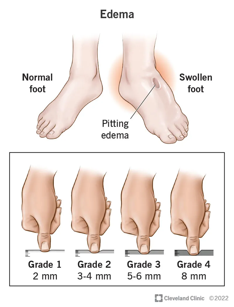Pitting Edema Clinical Presentation and Grading